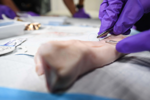 Eine Person in lila Handschuhen hält eine Schere und führt eine Akupunkturbehandlung an einem Patientens Bein durch, mit verschiedenen Gegenständen auf dem Tisch vor ihnen und einem unscharfen Hintergrund.