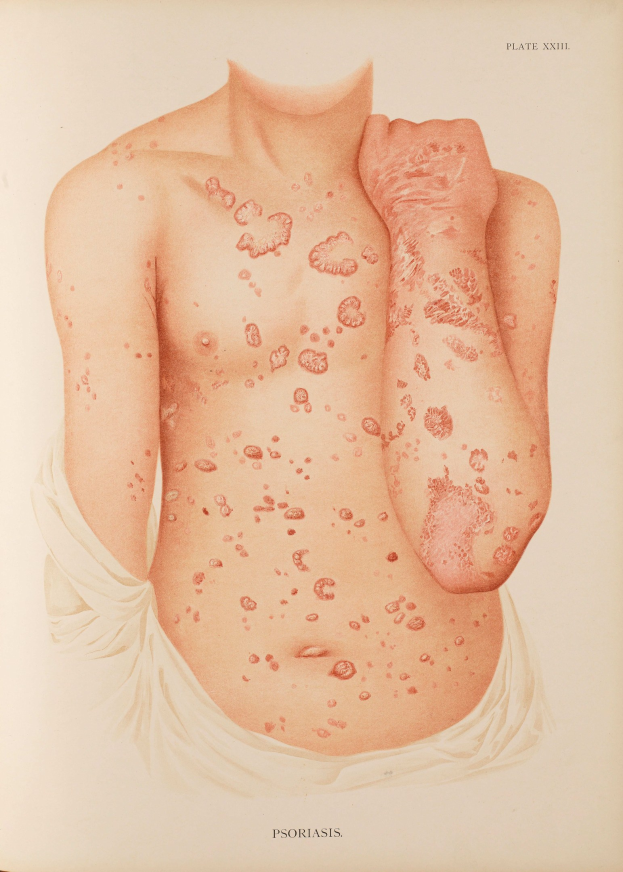 Buchumschlag mit einer Illustration eines Mannes, dessen Oberkörper mit roten Flecken bedeckt ist, die wahrscheinlich Psoriasis darstellen, und Text, der Informationen über die Erkrankung bereitstellt.